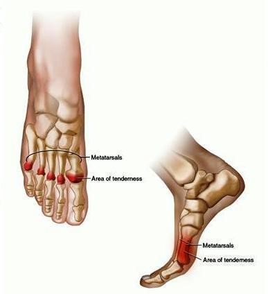 Příznaky onemocnění kloubu | Ostatní | Revmatoidní artritida - Revmatické nemoci
